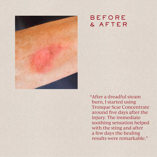 SOFT FOCUS Scar Concentrate
