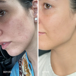 The Laser Serum - Triple Acid Concentrate
